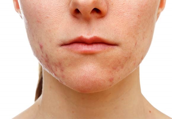 ایجاد حساسیت پوستی در فرمولاسیون آرایشی بهداشتی